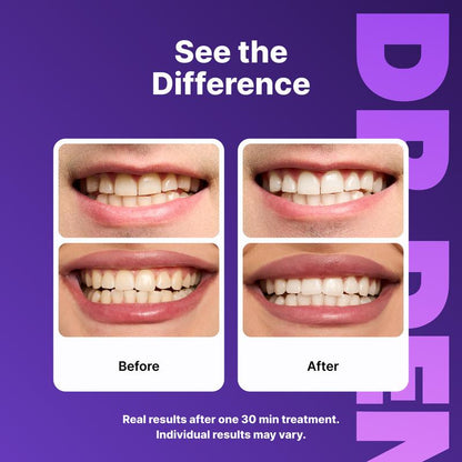 Purple Whitening Strips
