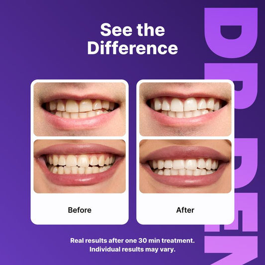 Purple Whitening Strips